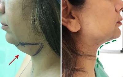 جراحی اصلاح زاویه و فرم گردن