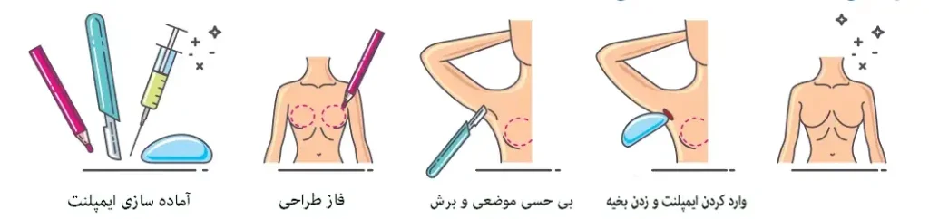 جراحی پروتز سینه | مراحل انجام جراحی بزرگ کردن سینه در اتاق عمل