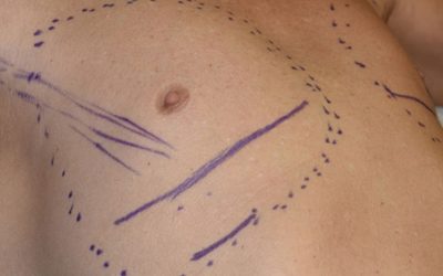 جراحی سینه در افراد ترنس با چه تکنیک‌هایی انجام می‌شود؟