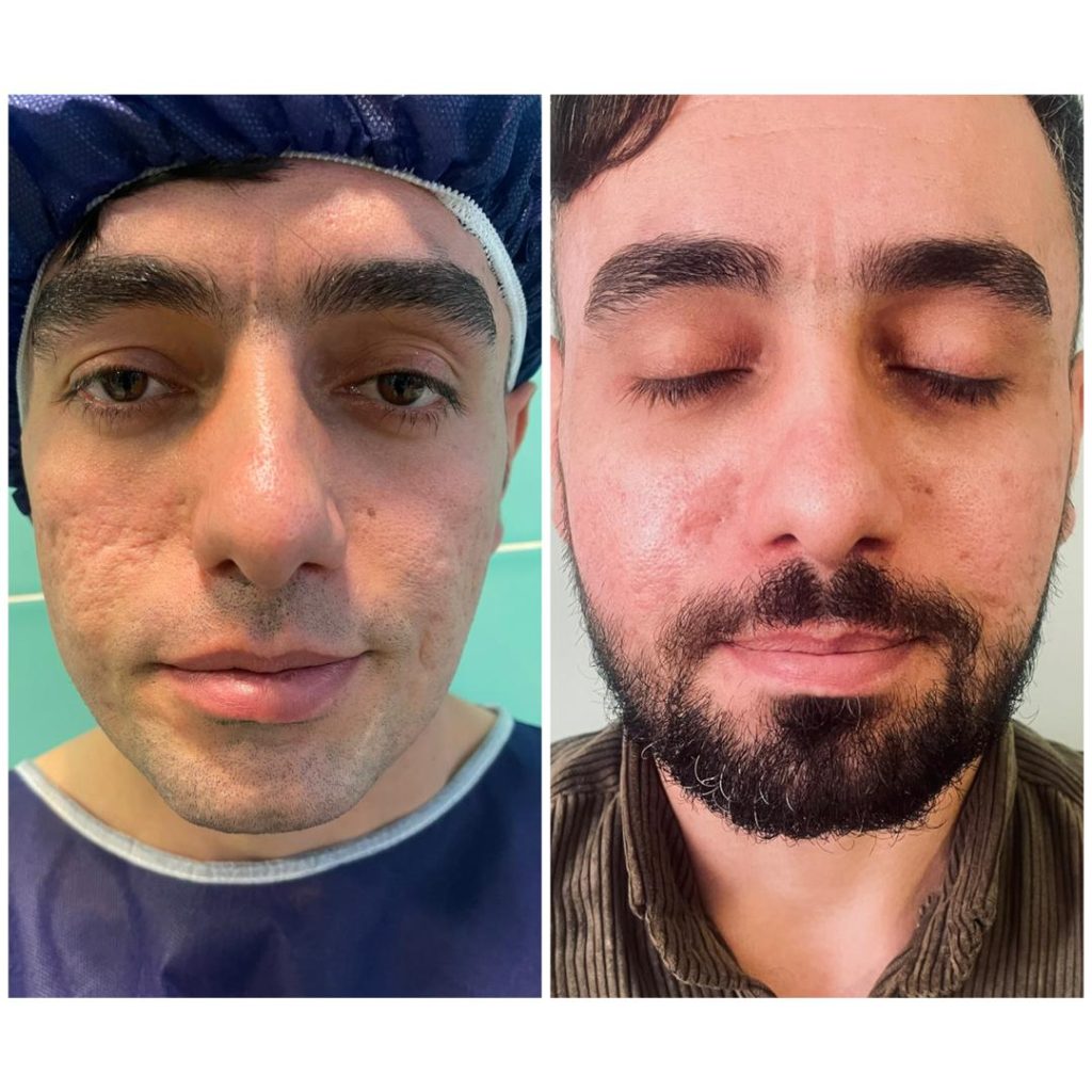 قبل و بعد تزریق چربی نانوفت برای پر کردن فرورفتگی جای جوش روی گونه