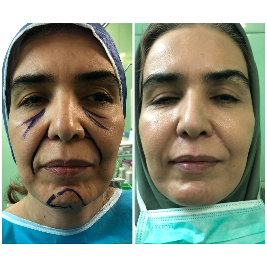 قبل و بعد تزریق نانوفت به زیر چشم و گونه با نتایج طبیعی و روشن‌تر شدن پوست