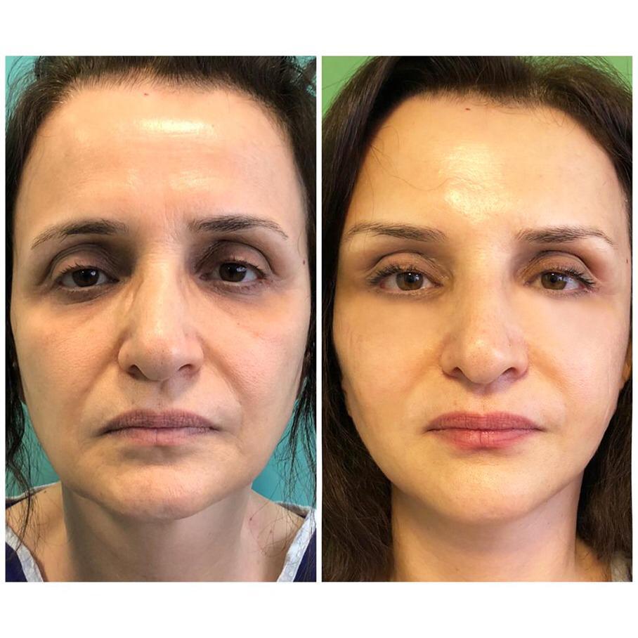 قبل و بعد تزریق نانوفت به زیر چشم و گونه با نتایج طبیعی و روشن‌تر شدن پوست