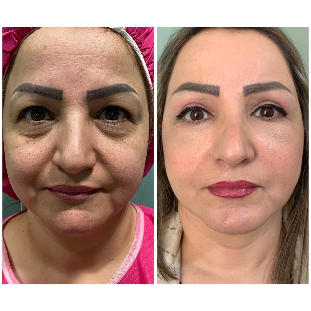 بهبود فرم صورت و جوانسازی با تزریق چربی – تصویر نتایج قبل و بعد درمان