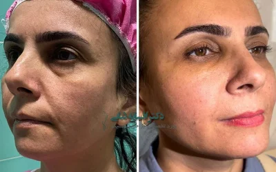 نوراریژن: معجزه‌ای نوین برای درمان لک و چین‌وچروک صورت