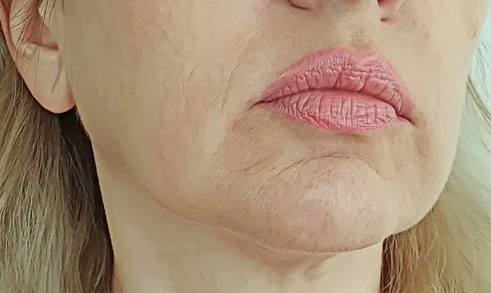افتادگی پوست صورت | روش‌های درمان افتادگی