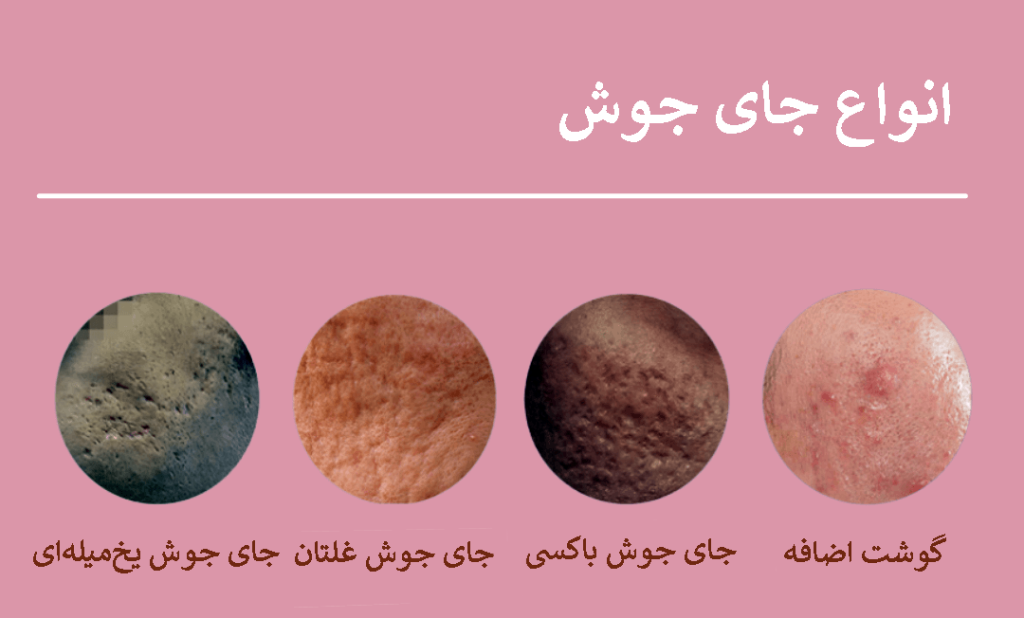 جای جوش | تصویر انواع جای جوش 