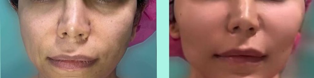 قبل و بعد از تزریق نوراریژن به دور لب و صورت