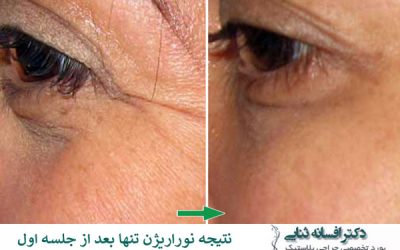 سوالات متداول درباره رفع چروک دور چشم (بوتاکس، فیلر و نوراریژن) 