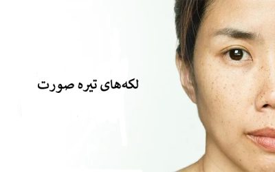 درمان‌های خانگی برای از بین بردن لک‌ صورت به‌طور طبیعی در یک شب