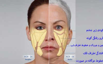 بازگرداندن حجم صورت