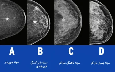 تراکم سینه و جراحی زیبایی سینه: آنچه باید بدانید