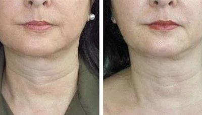 میکروبوتاکس (Microbotox): راز مدرن جوانسازی پوست بدون چهره یخ‌زده