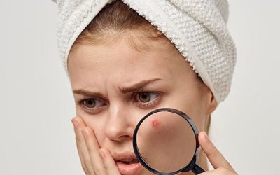 آیا لیفت صورت می‌تواند به بهبود جای جوش کمک کند؟